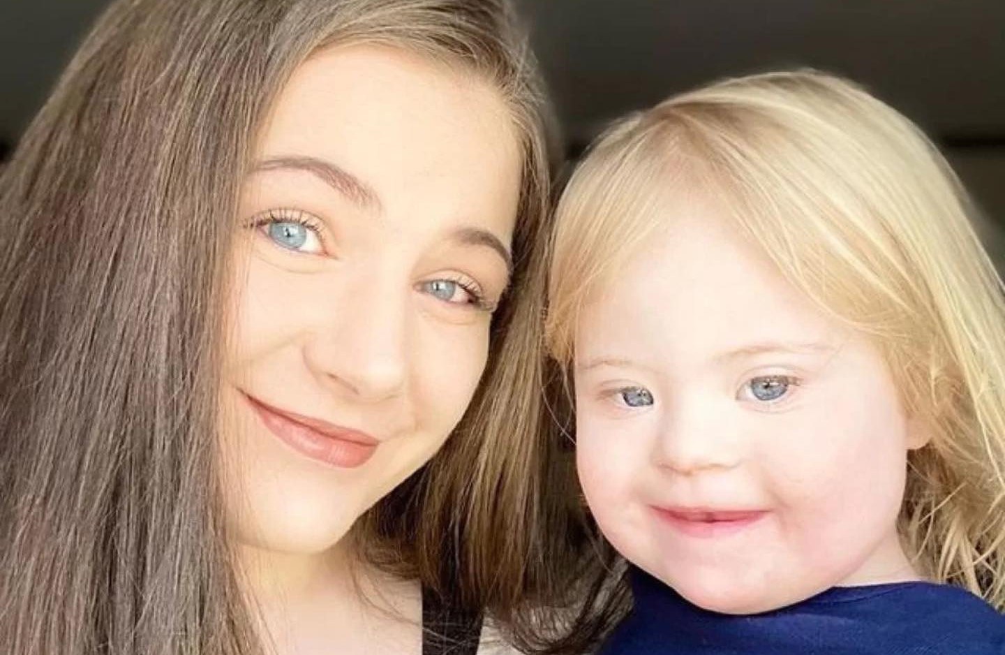 Mosaic Down Syndrome