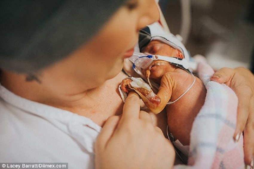 worlds smallest premature baby to survive