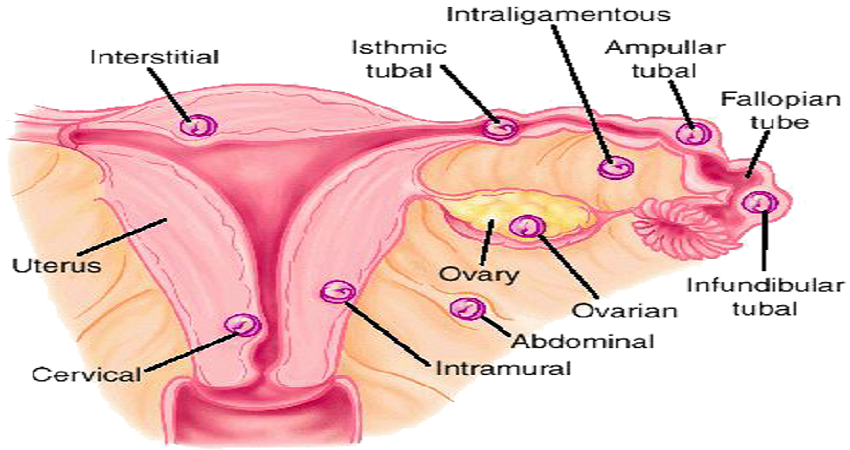 Dr.Kiruthiga Devi - Ectopic or tubal pregnancy occurs when the