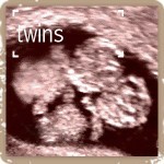 Ultrasound of twins